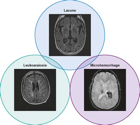 small vessel ischemic disease Cerebral csvd vascular svn bmj - Diseases ...