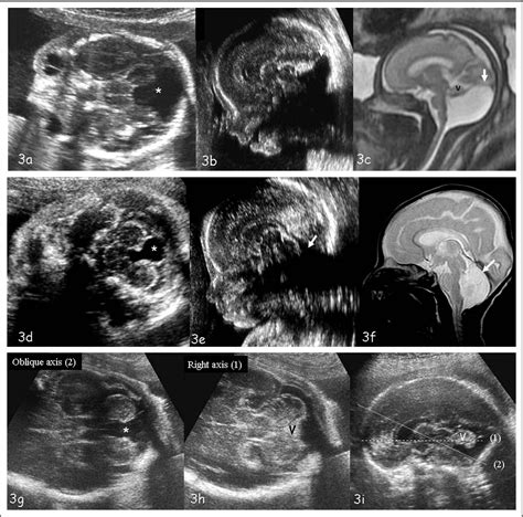 Figure 1 from The fetal cerebellum: development and common malformations. | Semantic Scholar