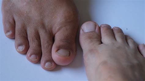 Most Common Tailor Bunion Surgery Complications Explained