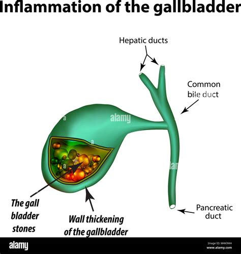 Inflamed Gallbladder Symptoms