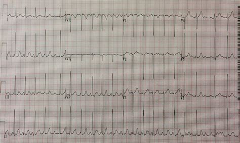 Dr. Smith's ECG Blog: Irregularly irregular supraventricular very fast rhythm: what is it?