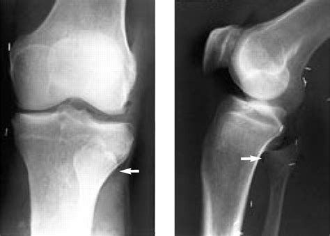 Proximal Tib-Fib Dislocation - Knee & Sports - Orthobullets