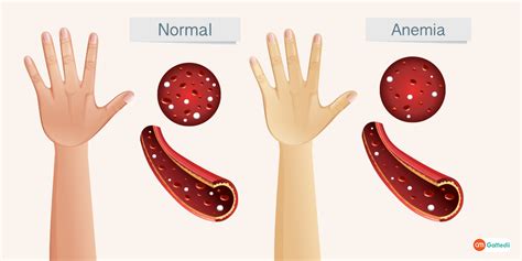 Iron Deficiency Anemia Symptoms