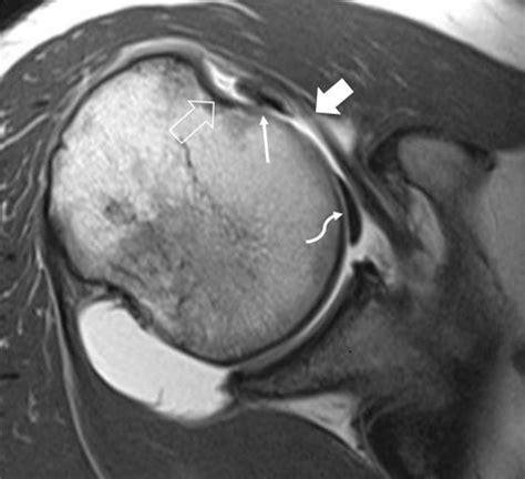 How to read mri images for a torn rotator cuff - alohadelta