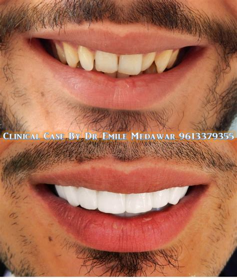 Beirut Veneer, Dr Emile Medawar, 00 961 3 379355: Dr Emile Medawar ...