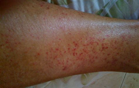 Photos of stasis dermatitis | Symptoms and pictures