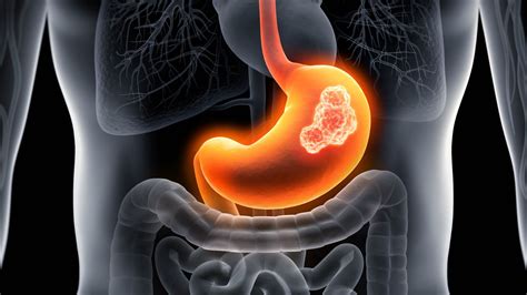 8 Common Symptoms of Gastric Cancer - Health News Hub