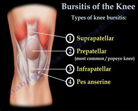 Knee Bursitis,prepatellar bursitis - Everything You Need To Know - Dr. Nabil Ebraheim - YouTube