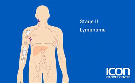 What is Lymphoma? Lymphoma Explained | Icon Cancer Centre