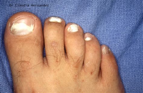 White Superficial Onychomycosis: Types, Symptoms, Causes & Treatment