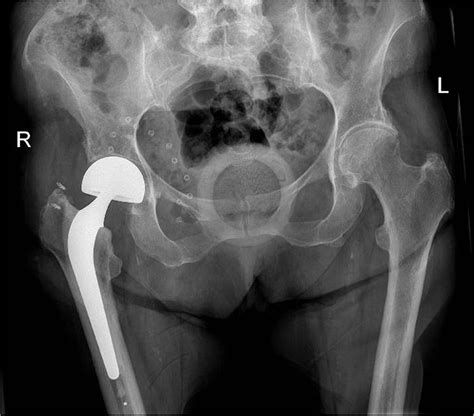 Dislocation and dissociation of bipolar hip hemiarthroplasty | BMJ Case ...