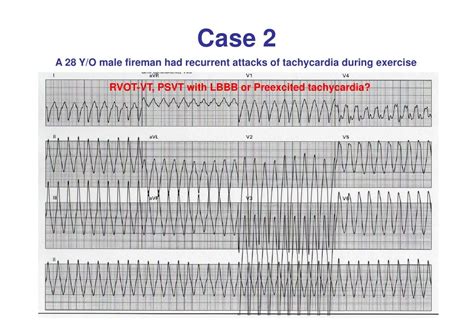 Differentiation between AVNRT and AVRT_advanced lecture