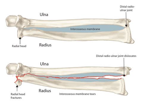 Interosseous Membrane Arm