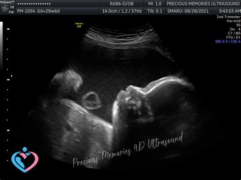 Pregnancy Ultrasound Image Gallery - 25 - 32 Weeks