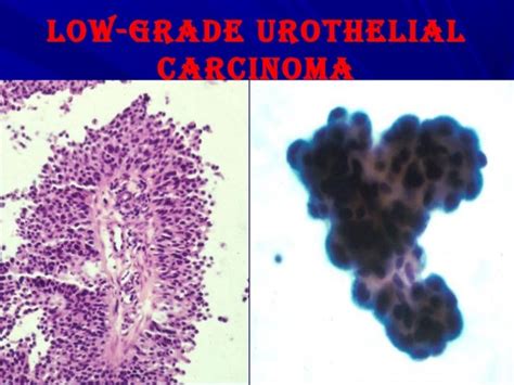 Urine.cytology