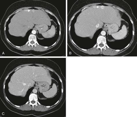 Benign Tumors of the Liver | Radiology Key