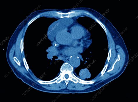 Lung cancer, CT scan - Stock Image - C001/7445 - Science Photo Library
