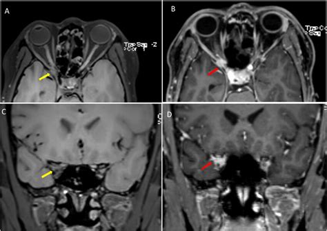 -MRA Head [(A) T1 axial, (B) T1 axial postcontrast, (C) coronal T1, and ...