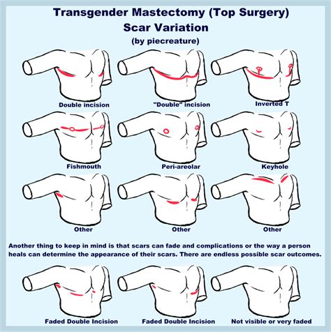 Top Surgery Scars by PieCreature on DeviantArt