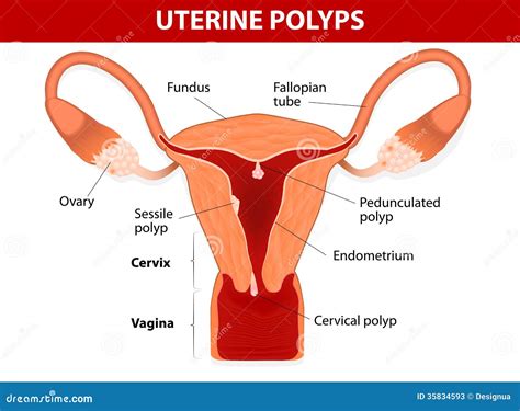 Cervical Polyps. Uterus With Cervix Marked With Lines. Small And Large ...