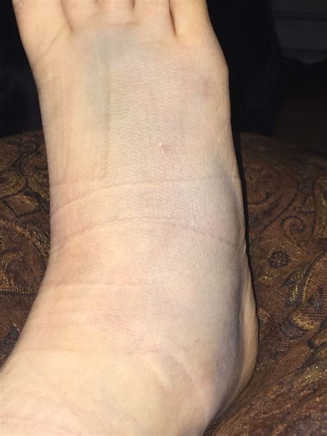 My 5th metatarsal fracture, commonly known as a Jones Fracture. Swelling and bruising due to ...