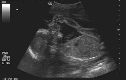 Breech Presentation - Obstetrics - Medbullets Step 2/3