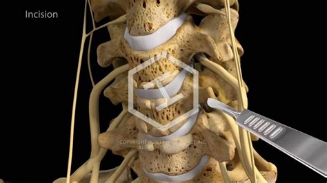 c5-c6-c7 Anterior Cervical Discectomy with Fusion - YouTube | Cervical, How are you feeling, Fusion