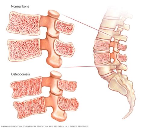 How To Check For Bone Density - Ademploy19