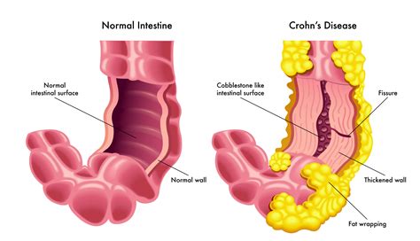 CE Activity | Cutaneous Crohn Disease | Nurses