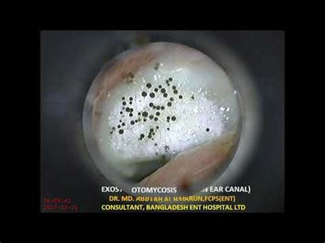 EAR INFECTIONS - YouTube