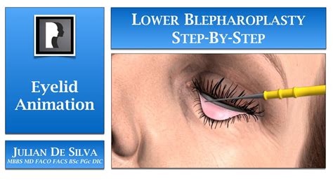 Lower Blepharoplasty Procedure