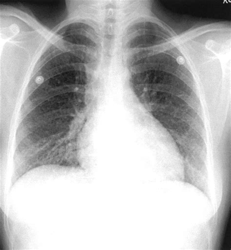 A 28 year old woman with ventricular tachycardia and an abnormal chest ...