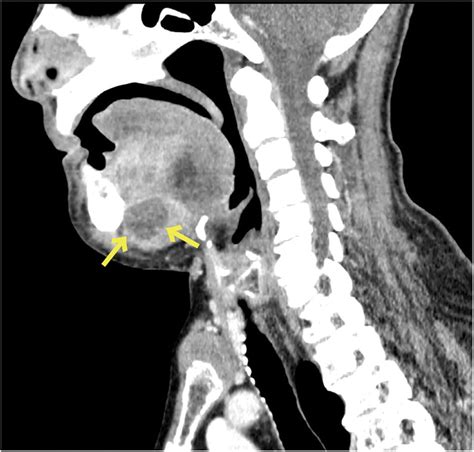 Ludwigs Angina Radiology