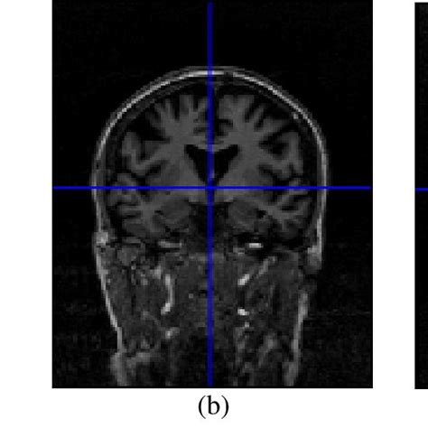 MRI Centered at Anterior Cingulate Cortex Position: (a) Axial, (b ...