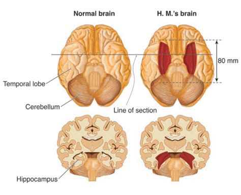 Patient H.M. Case Study In Psychology: Henry Gustav Molaison