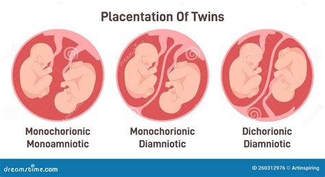 Twin Types. Monozygotic or Dizygotic Placentation of Twins ...