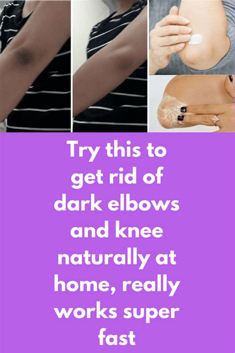 Instant natural remedies for dark and dry elbows! | Dry skin remedies, Dark elbows, Skin remedies