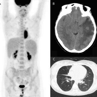 (A) PET/CT scan in October 2021. High radiotracer uptake is seen in the... | Download Scientific ...