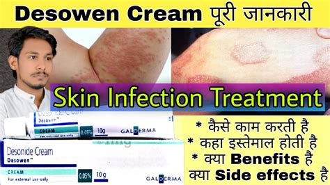 Desowen Cream | Desonide Cream 0.05 w/w | Dose | Content | Side Effects | Precautions - YouTube