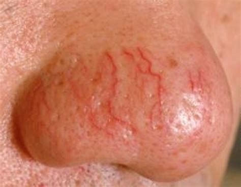 Telangiectasia - Pictures, Symptoms, Causes, Treatment | HubPages