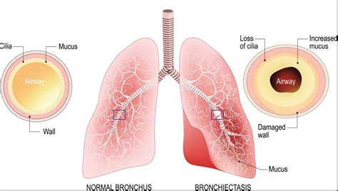 Causes Of Blood In Mucus