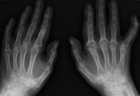 Psoriatic arthritis – hands - Radiology at St. Vincent's University ...