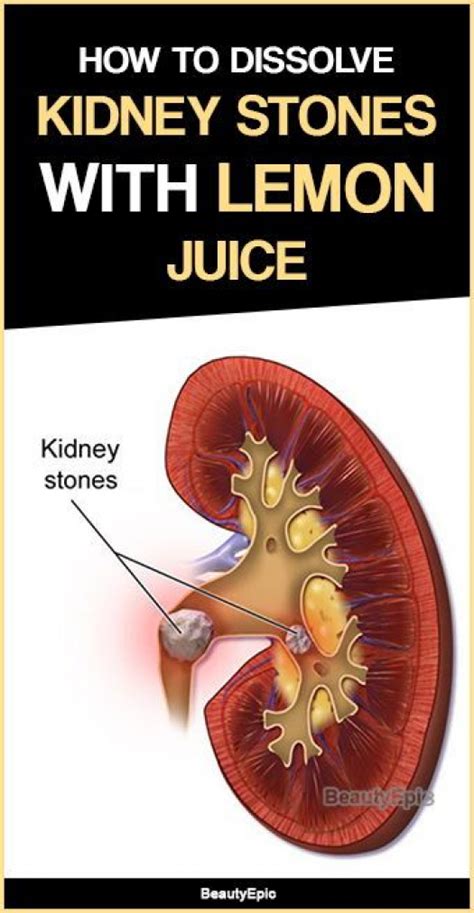 Lemon Juice for kidney stones #detoxsmoothie in 2020 | Kidney stones remedy, Kidney stone diet ...