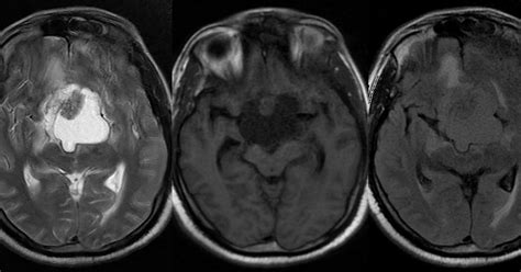 Dr Balaji Anvekar FRCR: Craniopharyngioma