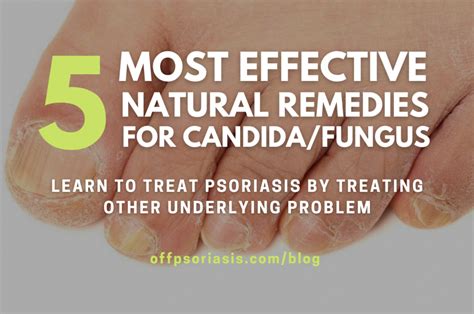4 Most Effective Natural Remedies that treat Candida and not only… – OffPsoriasis