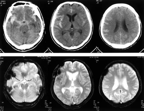 Detection of Hemosiderin Deposition by T2*-Weighted MRI After Subarachnoid Hemorrhage | Stroke