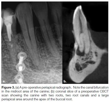 root canal treatment canine teeth