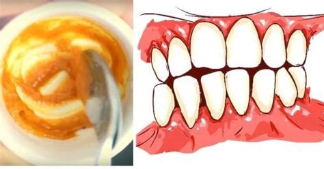 This Homemade Toothpaste Reverses Gum Disease and Whitens Teeth!