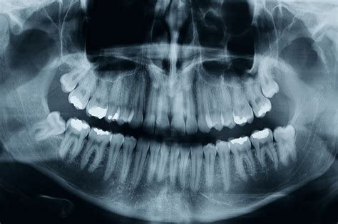 bigstock-Dental-Xray-76646633 - Bluegrass Oral Health Center