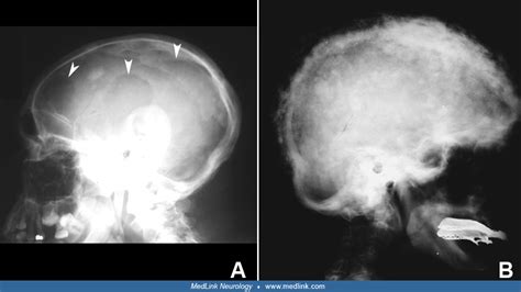 Paget disease of bone: neurologic complications | MedLink Neurology